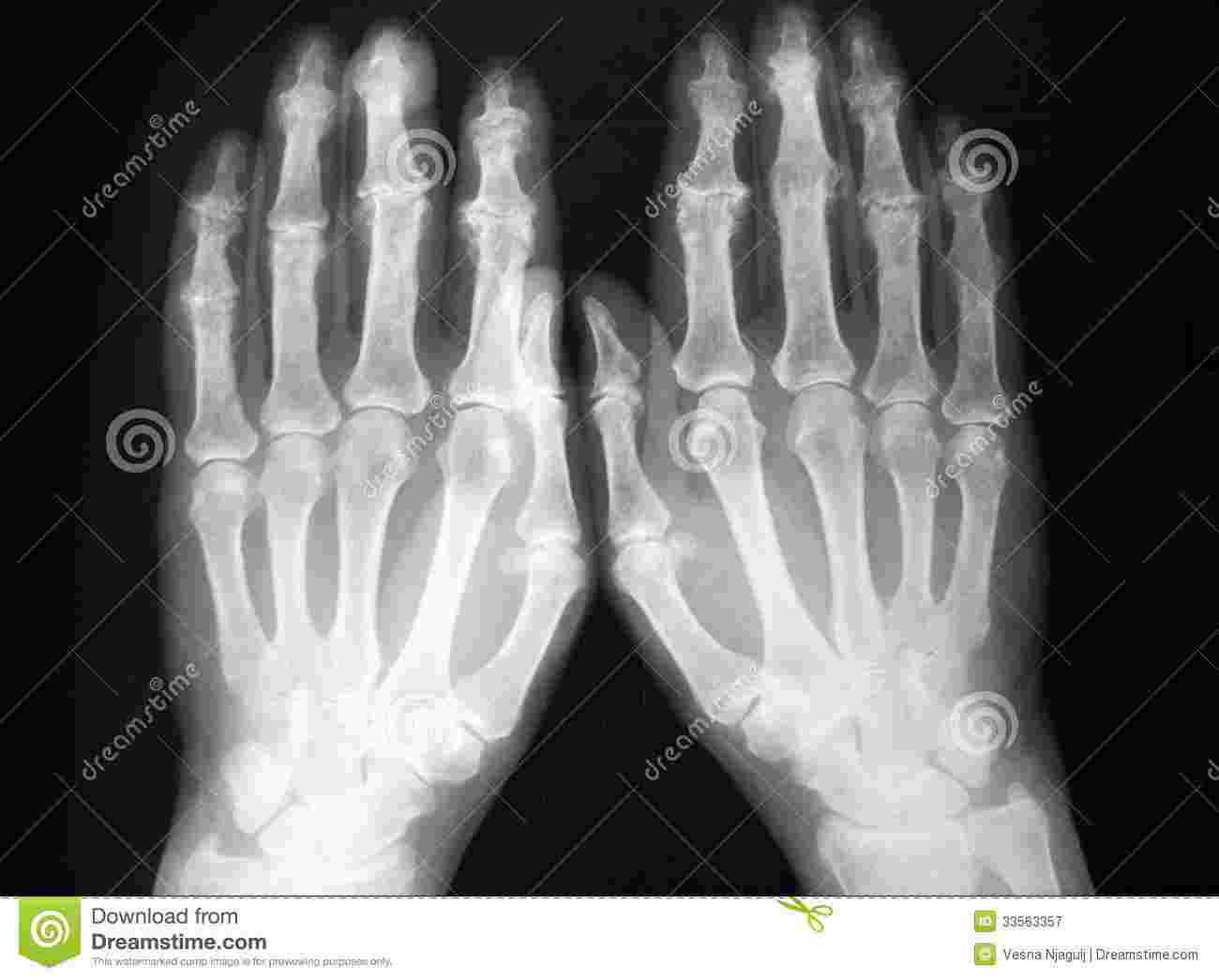 https://pbcdn1.podbean.com/imglogo/ep-logo/pbblog20455383/arthritis-hand-XR.jpg